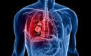 Residual ctDNA predicts relapse in lung cancer