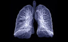 CT chest reveals fewer cases of pneumonia in breakthrough COVID-19 infections