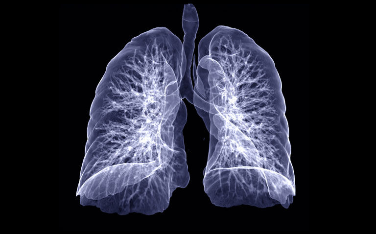 CT chest scans reveal fewer cases of pneumonia in breakthrough COVID-19 infections