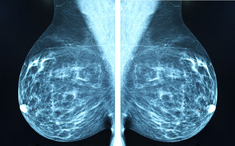 Dense breasts and benign disease on mammography linked to higher risk of future breast cancer in Asian women