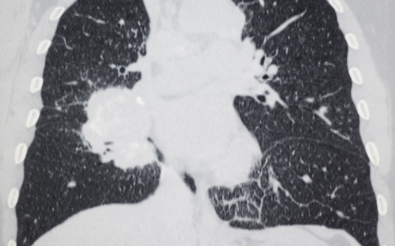 Systematic review suggests emphysema on CT scan associated with higher risk of lung cancer