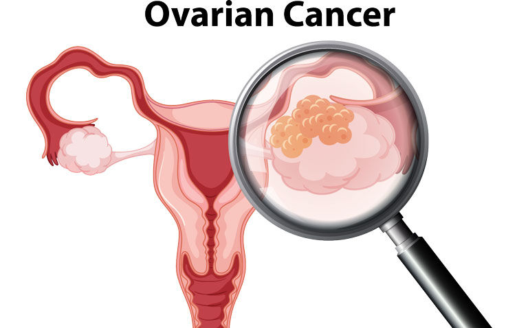 Apatinib addition to doxorubicin could be a potential treatment option in platinum-resistant recurrent ovarian cancer
