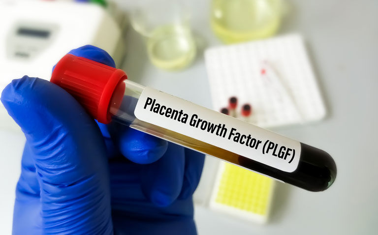 PlGF-based testing recommended for suspected  preterm pre-eclampsia