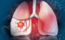 Canakinumab fails to improve disease-free survival in non-small cell lung cancer