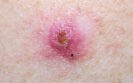 Basal cell carcinoma diagnosis improved with novel imaging technique