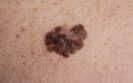 Low vitamin D levels linked to worse overall survival in invasive melanoma