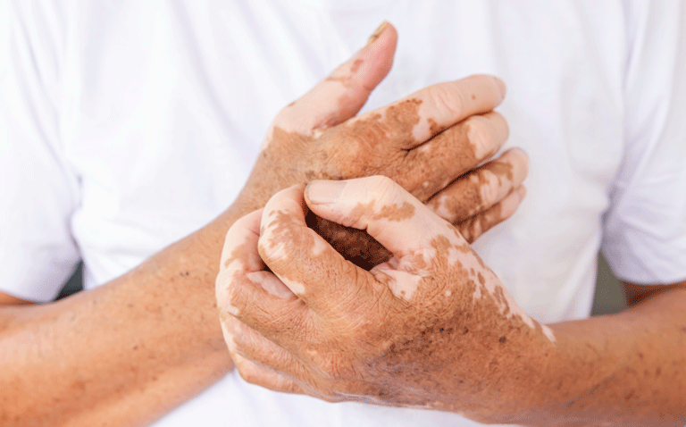 Topical ruxolitinib effective in non-segmental vitiligo