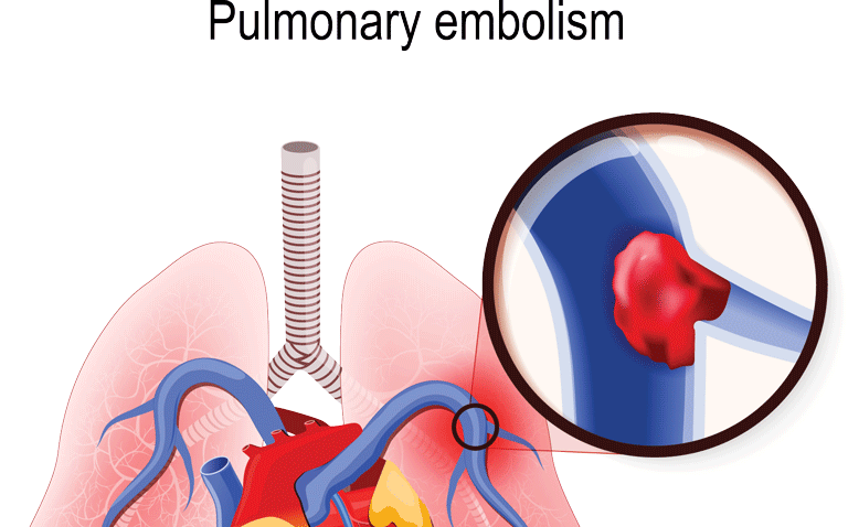 NEWS adequate for ICU and mortality predictions in acute pulmonary embolism