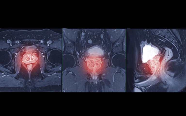 Prostate cancer screening with MRI after PSA a cost-effective strategy