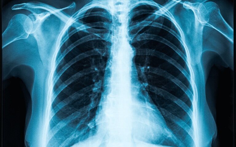 AI model predicts CVD risk from single chest radiograph