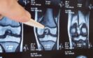 MRI study suggest NSAIDs may worsen arthritis inflammation