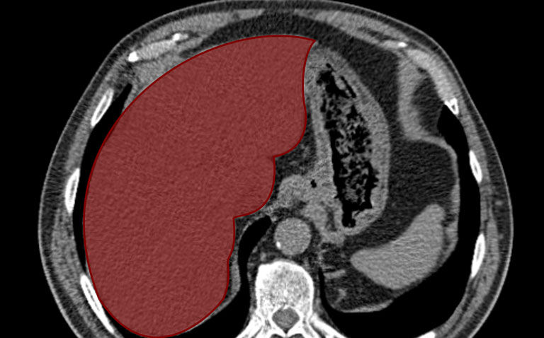 Contrast-enhanced CT enables prediction of treatment response in liver cancer