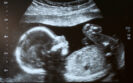 Gestational age estimation more accurate with AI compared to standard biometry