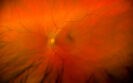Hydroxychloroquine induced retinopathy risk less than 10% over 15 years