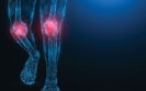 Osteoarthritis progression identifiable using plasma proteomics signature