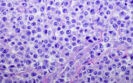 T cell biomarker predicts CAR T cell therapy response in relapsed lymphoma