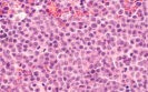 Yescarta approved by NICE for relapsed/remitted lymphomas