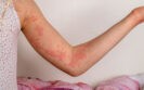 Dupilumab treatment improves spontaneous chronic urticaria activity and quality of life