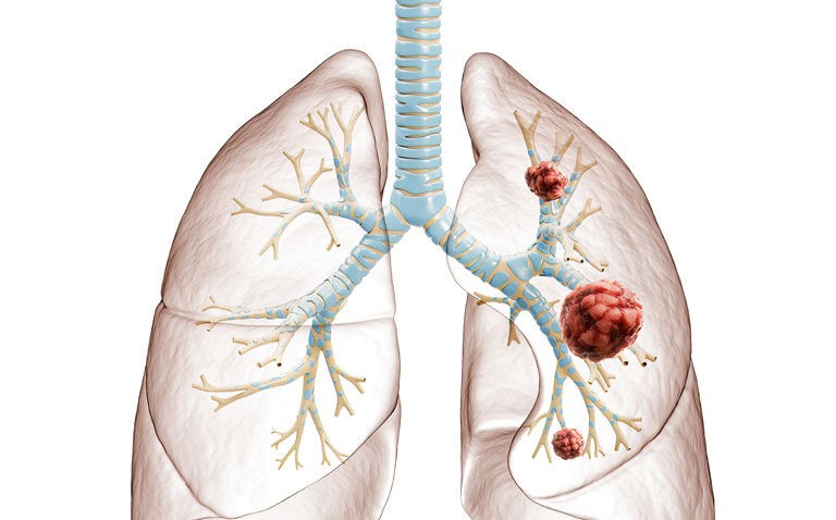 Neoadjuvant nivolumab provides significant 5-year overall survival in lung cancer