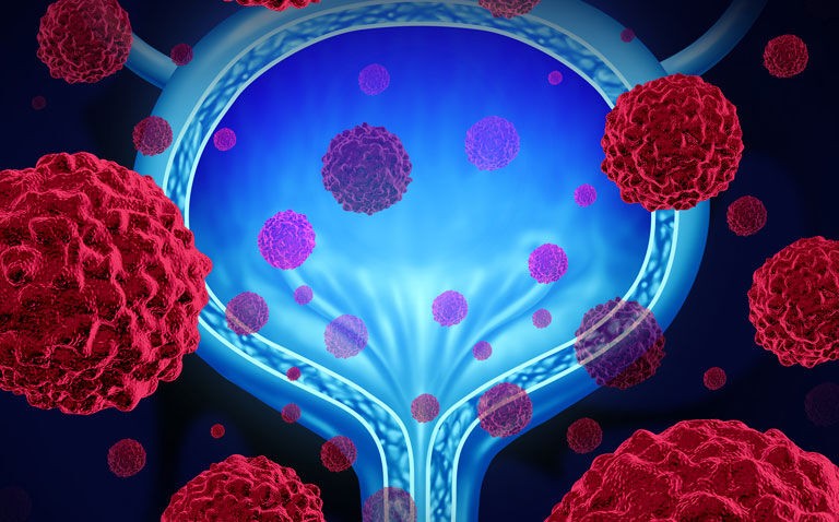 Pembrolizumab shows benefit in high-risk BCG non-responsive bladder cancer