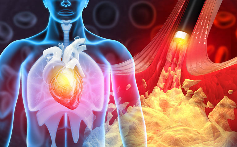 Both forms of cardiovascular disease associated with higher cancer risk