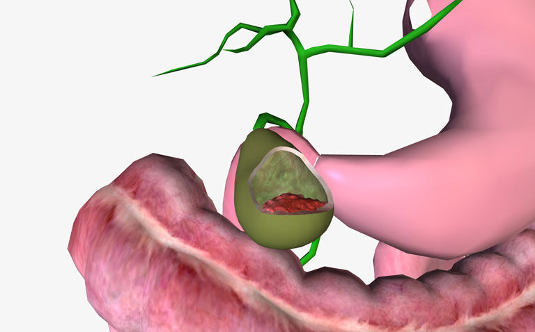 Pembrolizumab explored in the treatment of  advanced biliary tract cancer