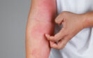RCT finds tralokinumab effective in adolescents with moderate to severe atopic eczema