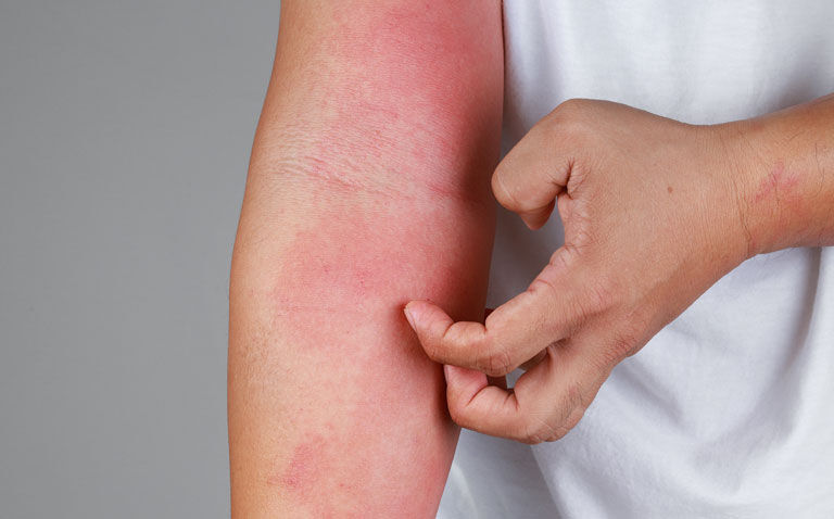 RCT finds tralokinumab effective in adolescents with atopic eczema
