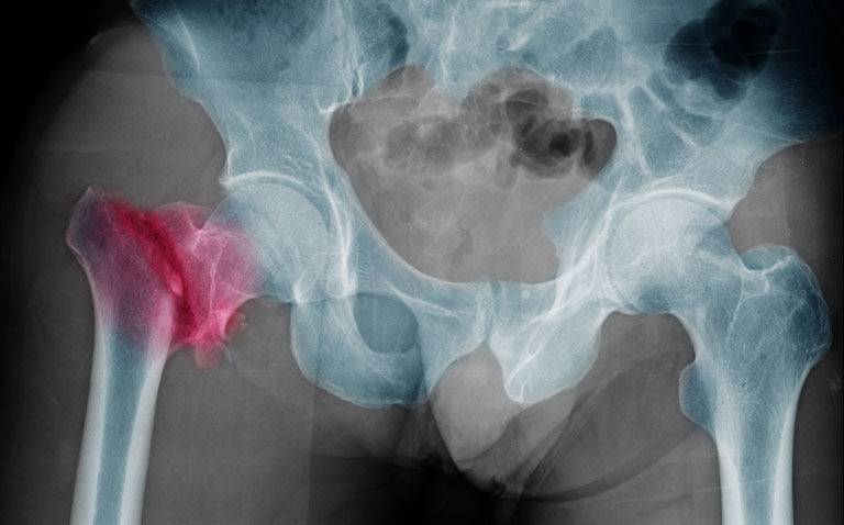 Review finds AI model diagnostic performance for hip fractures similar to expert clinicians
