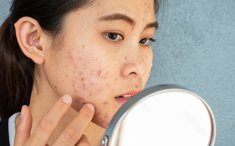 Ceramide routine significantly reduces local adverse effects from topical acne therapy
