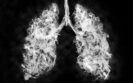 England's first-ever lung cancer screening programme to see national rollout