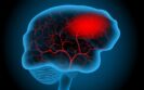 Potential for desmopressin to help patients on antiplatelets experiencing intracerebral haemorrhage