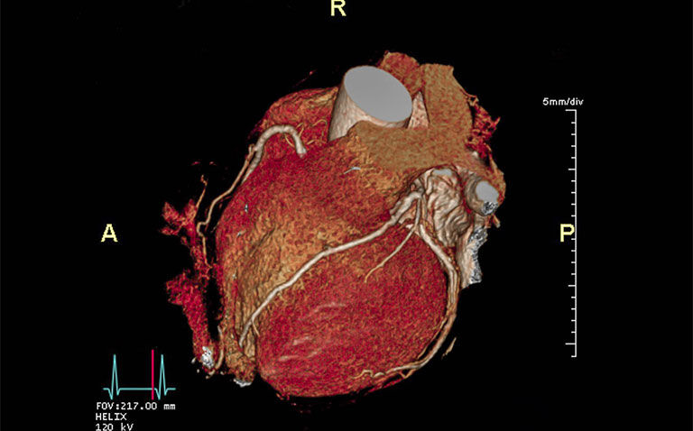 Ultrahigh resolution CT enables coronary artery disease diagnosis in high-risk patients