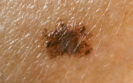 Melanoma in situ and mortality: is there cause for concern?