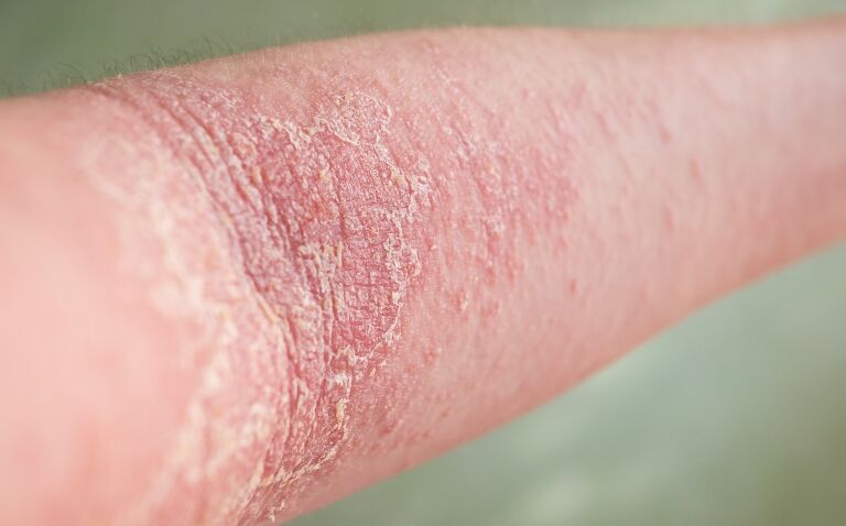 Amlitelimab found to improve disease severity in moderate to severe atopic dermatitis