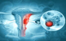 Novel MOv18 IgE antibody shows potential as ovarian cancer therapy
