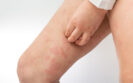 Monthly eblasakimab dosing effective in moderate to severe atopic eczema