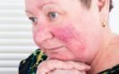 Paroxetine found to be effective for refractory erythematous rosacea