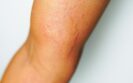 Chronic spontaneous urticaria shows clinically meaningful improvement with remibrutinib