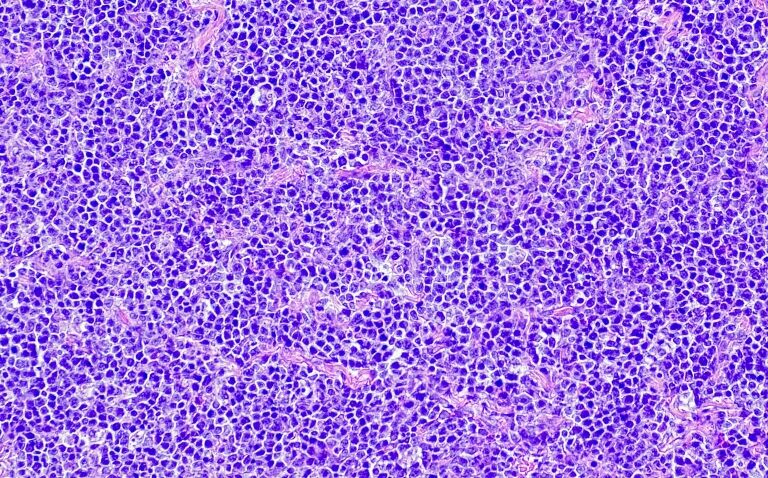 Novel injectable bispecific antibody for advanced lymphoma receives EU and UK green light