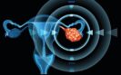 Positive CHMP opinion for rucaparib in advanced ovarian cancer