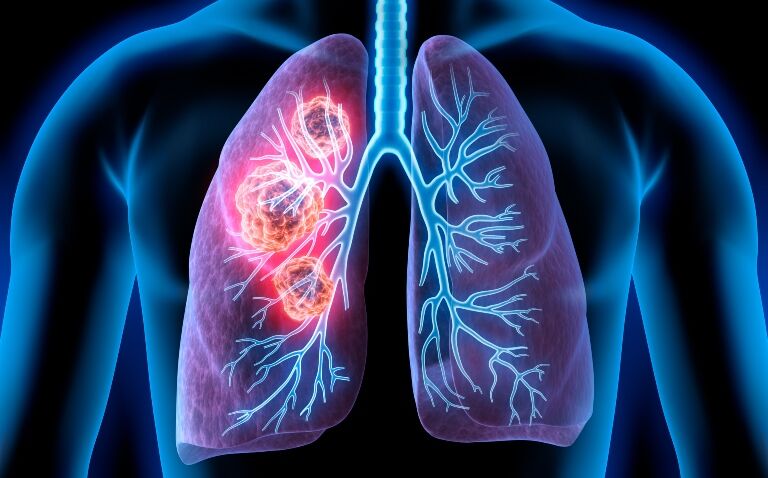 Adagrasib approved in the UK for NSCLC after earlier EU rejection