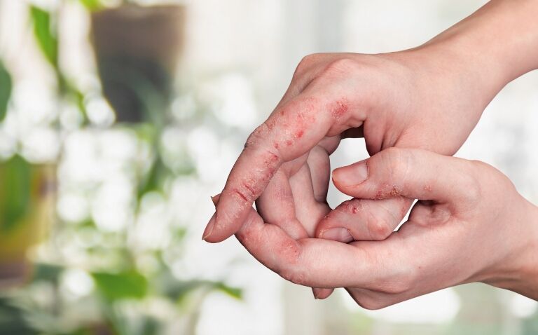 Delgocitinib cream shows promise in moderate-to-severe chronic hand eczema
