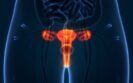 New standard of care for advanced cervical cancer recommended by researchers