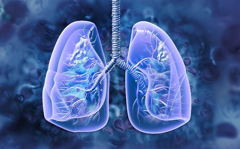 Lung cancer screening could be ‘game changer’ in Scotland, Wales and Northern Ireland