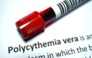 Managing blood cancer: Claire Harrison on ruxolitinib for polycythemia vera