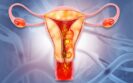 Dostarlimab approved for eligible patients with endometrial cancer in EU treatment milestone