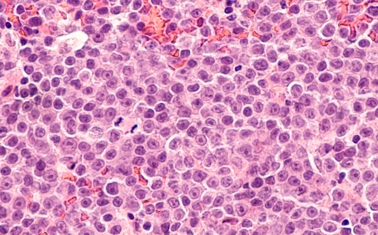 Epcoritamab recommended by NICE for diffuse large B-cell lymphoma after two or more lines of treatment