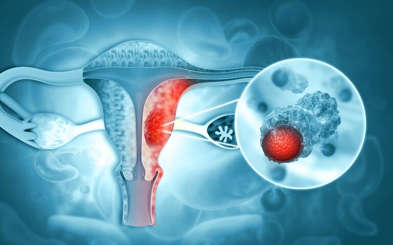 Dostarlimab given NICE go-ahead in first-line combination treatment for endometrial cancer