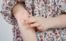 Specific subpopulations of children with atopic dermatitis linked to cognitive impairment
